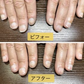 富士市 ネイルサロン MION 深爪・自爪育成のビフォーアフター